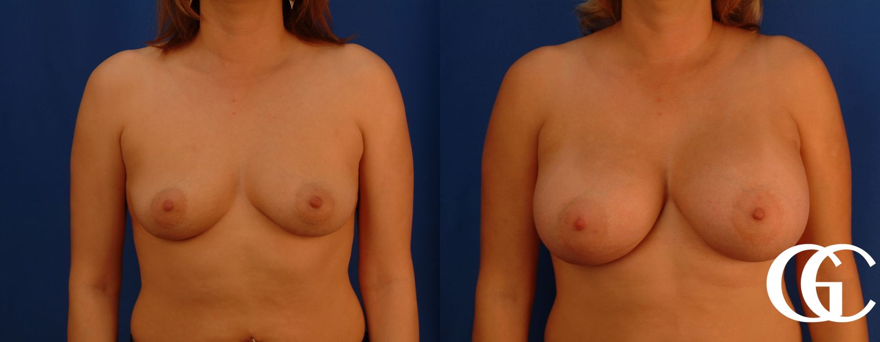 Breast Augmentation - Thumbnail 2