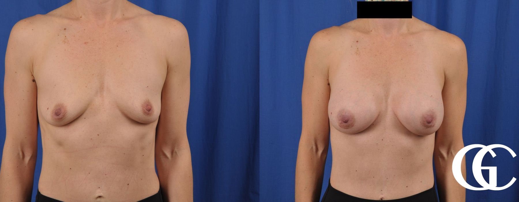 Breast Augmentation - Thumbnail 2