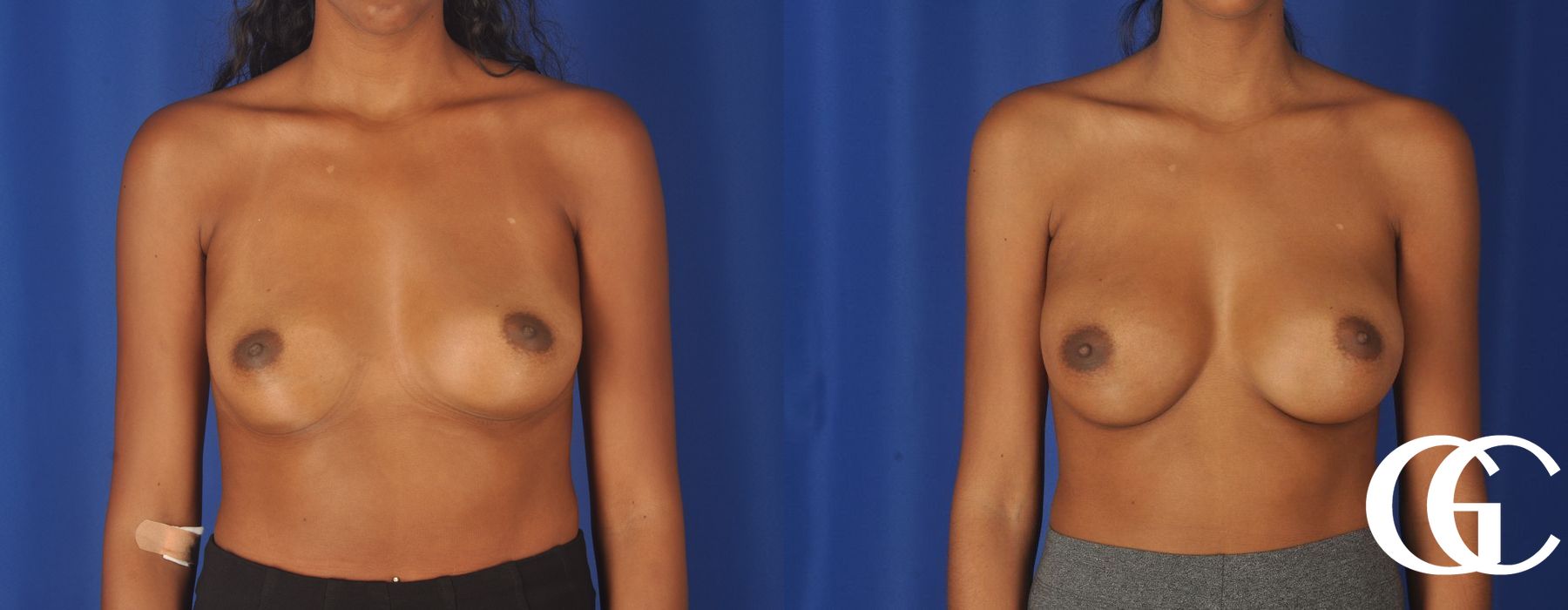 Breast Augmentation - Case 7167