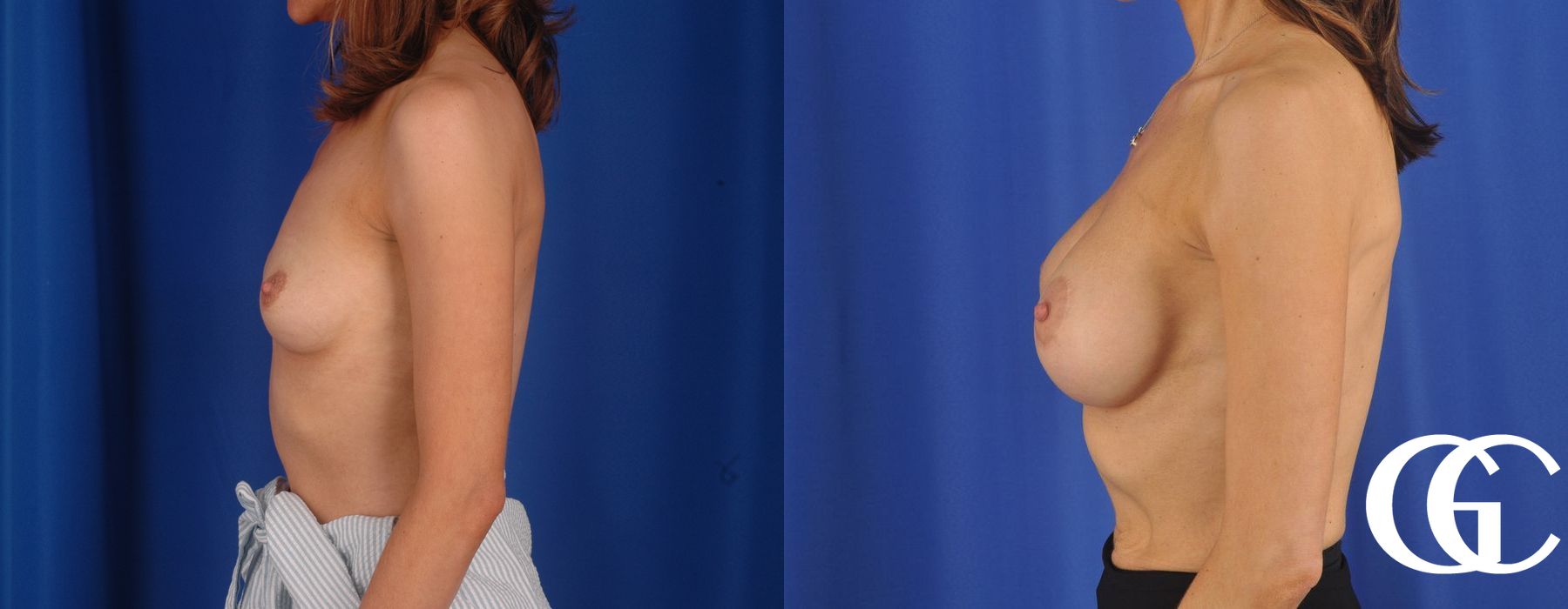 Breast Augmentation - Thumbnail 2