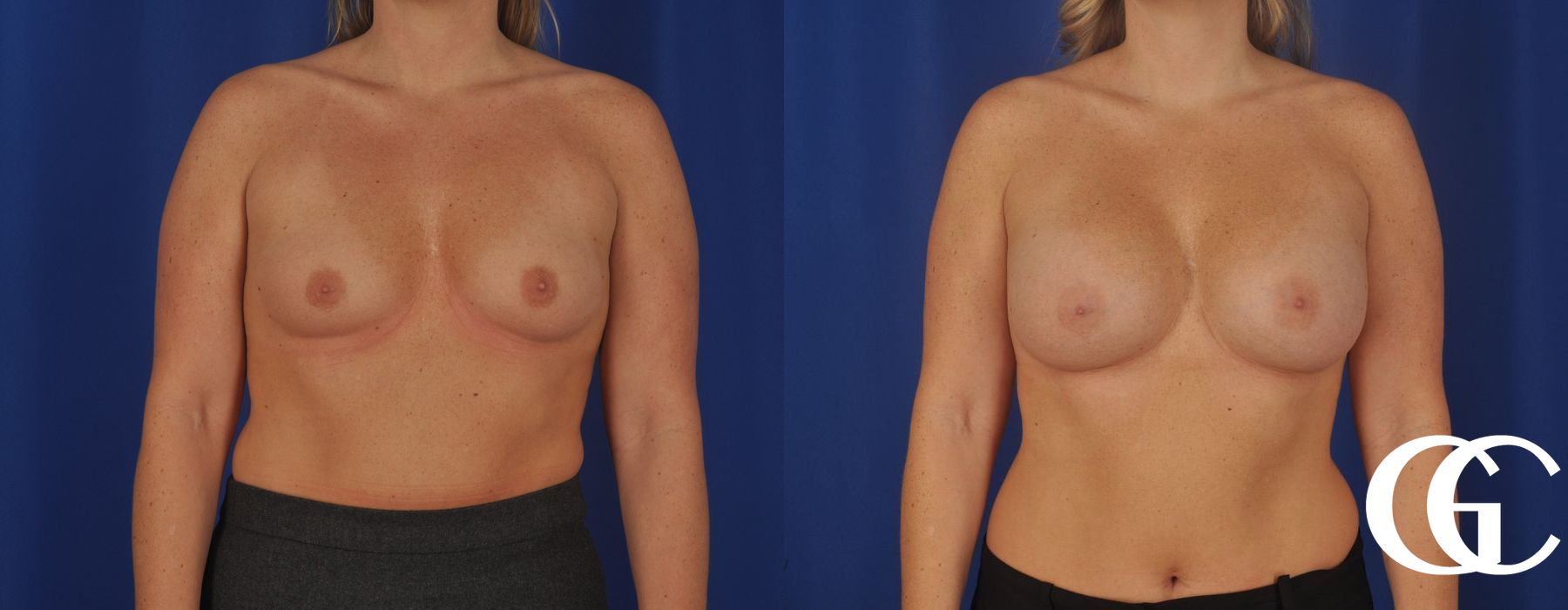 Breast Augmentation - Case 7220
