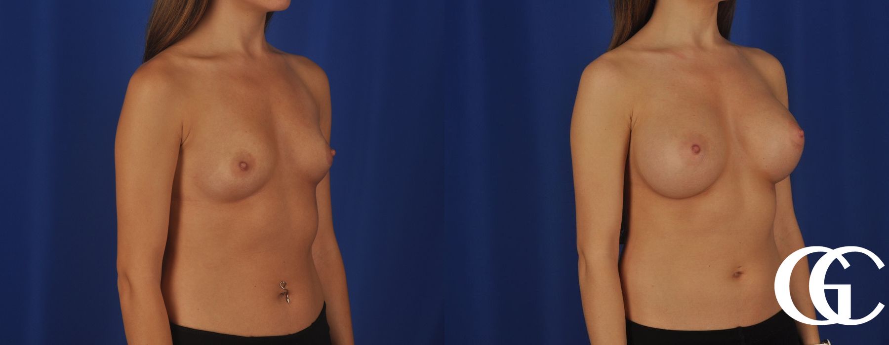 Breast Augmentation - Thumbnail 2