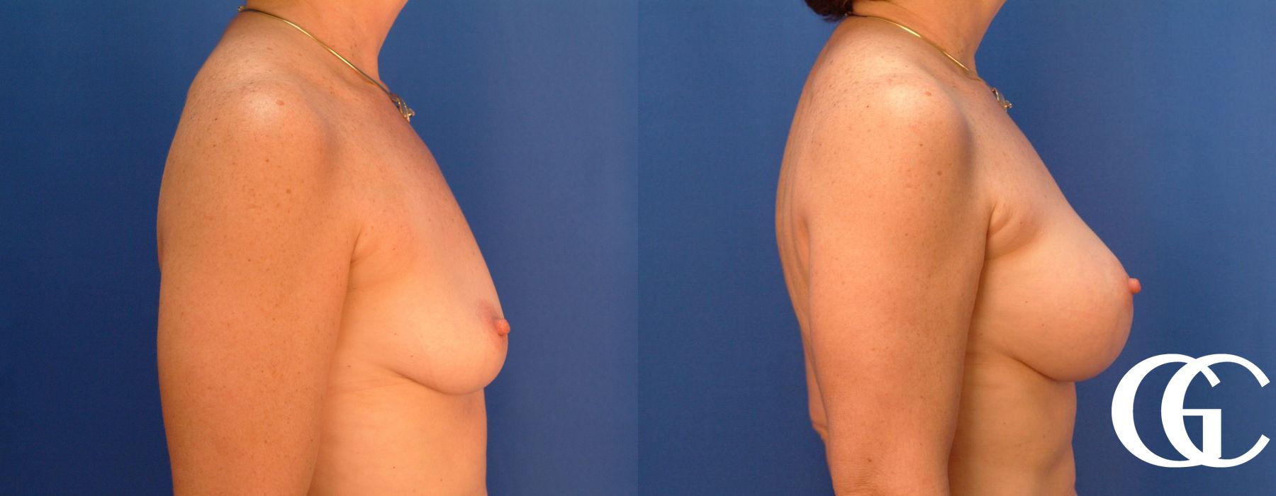 Breast Augmentation - Thumbnail 3