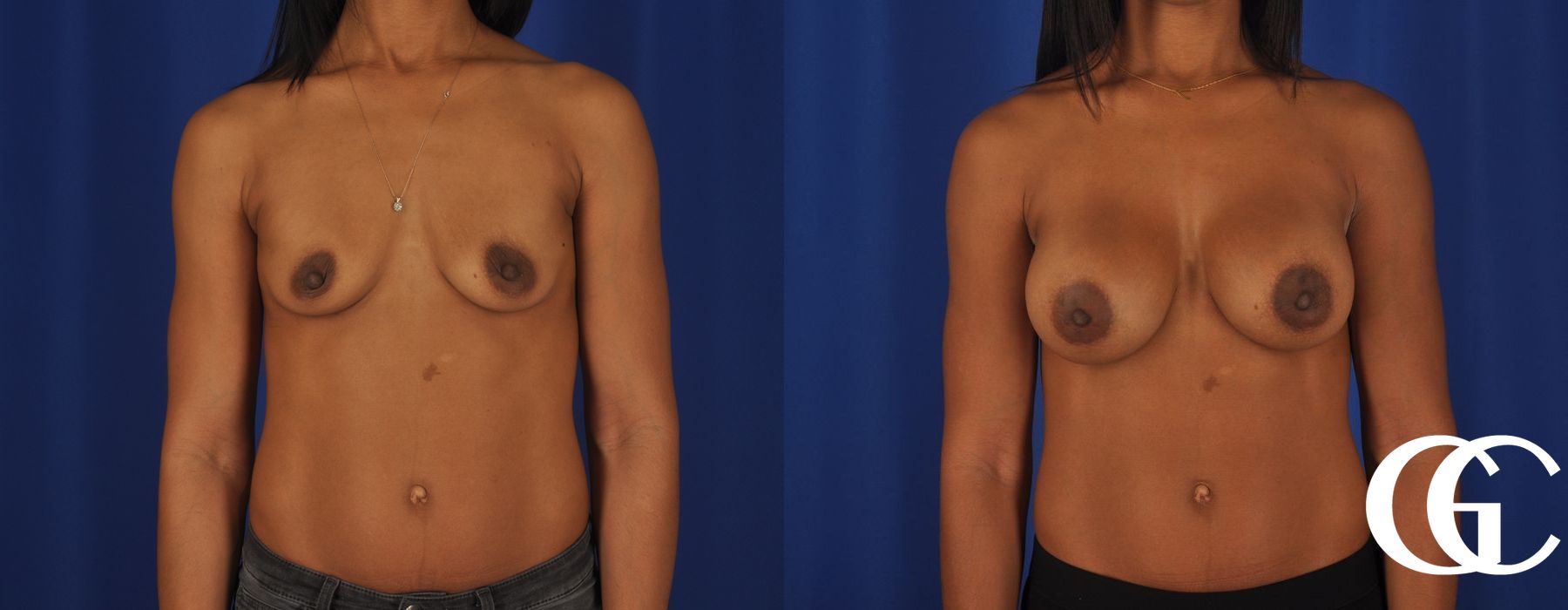 Breast Augmentation - Case 7129
