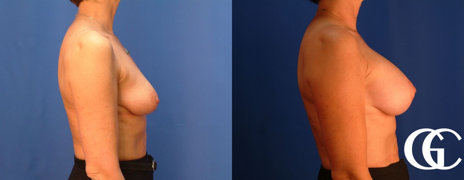 Breast Augmentation - Thumbnail 3