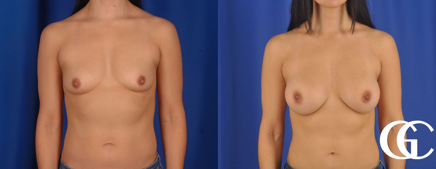 Breast Augmentation - Thumbnail 2
