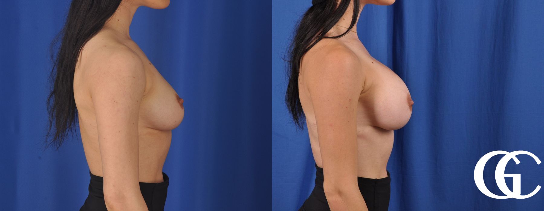 Breast Augmentation - Thumbnail 3