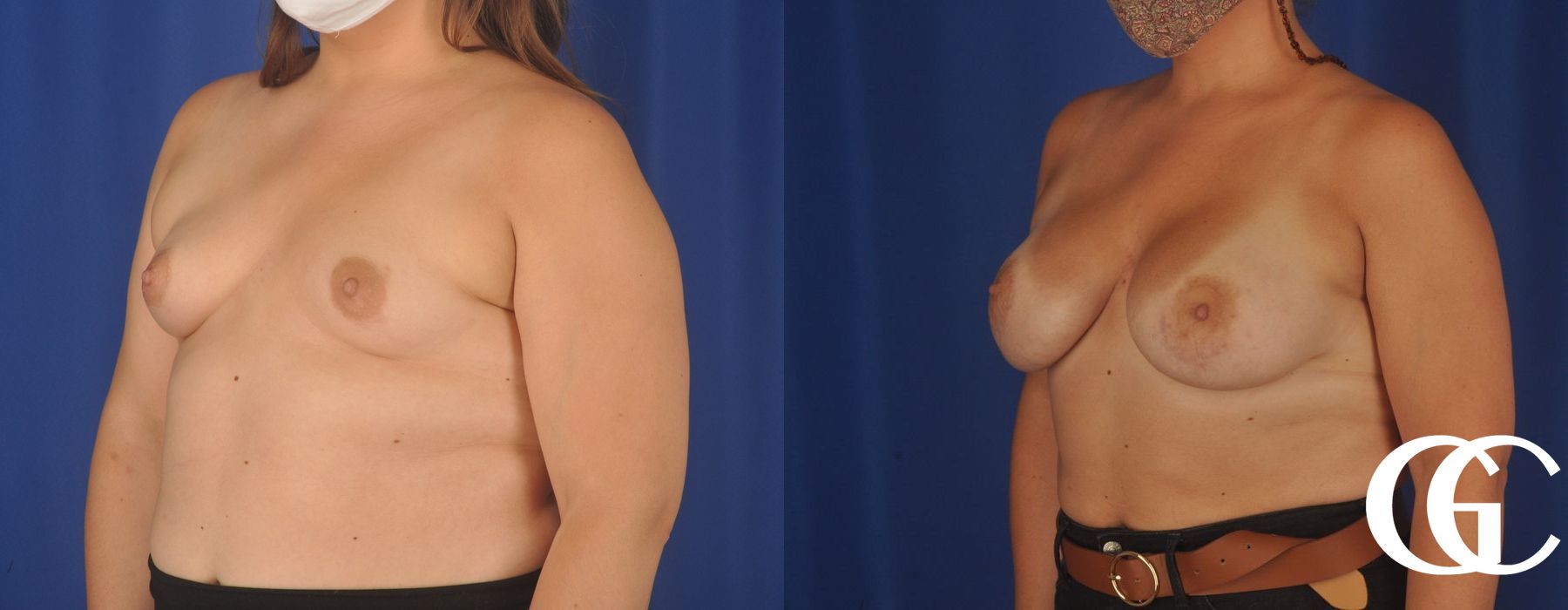 Breast Augmentation - Thumbnail 2