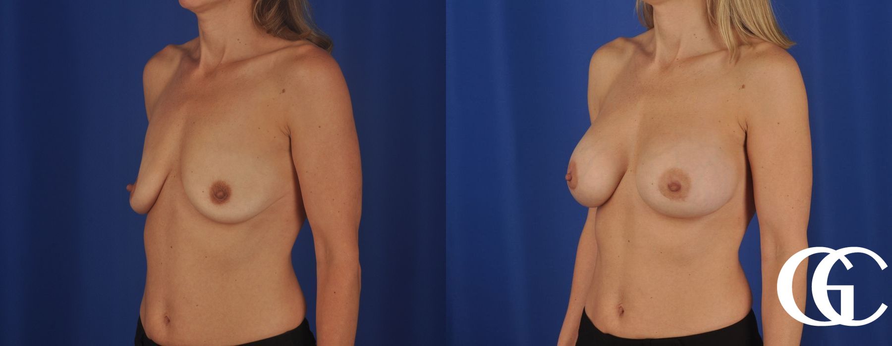 Breast Augmentation - Case 7155