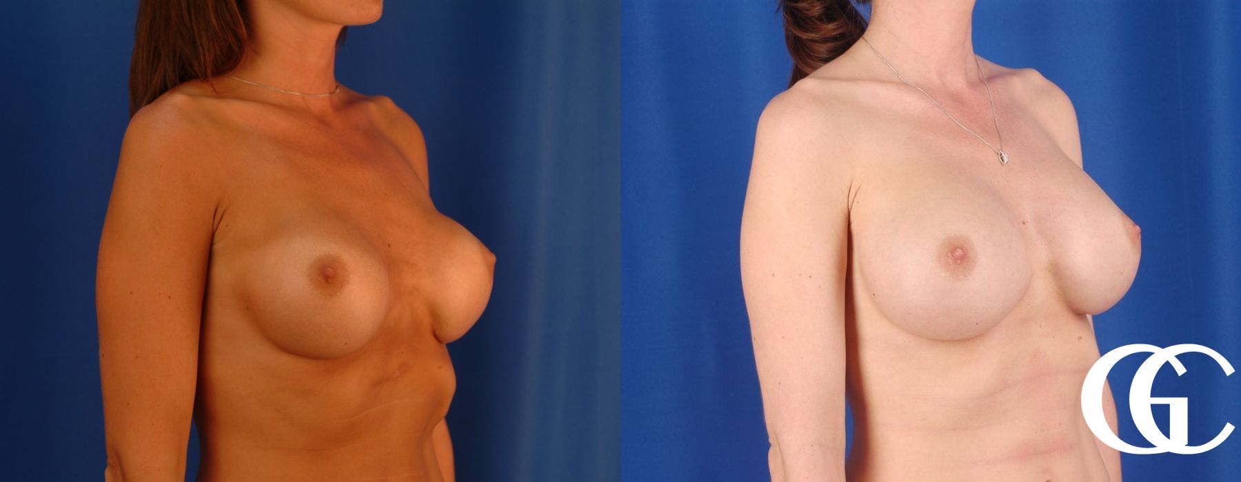 Breast Augmentation - Thumbnail 4