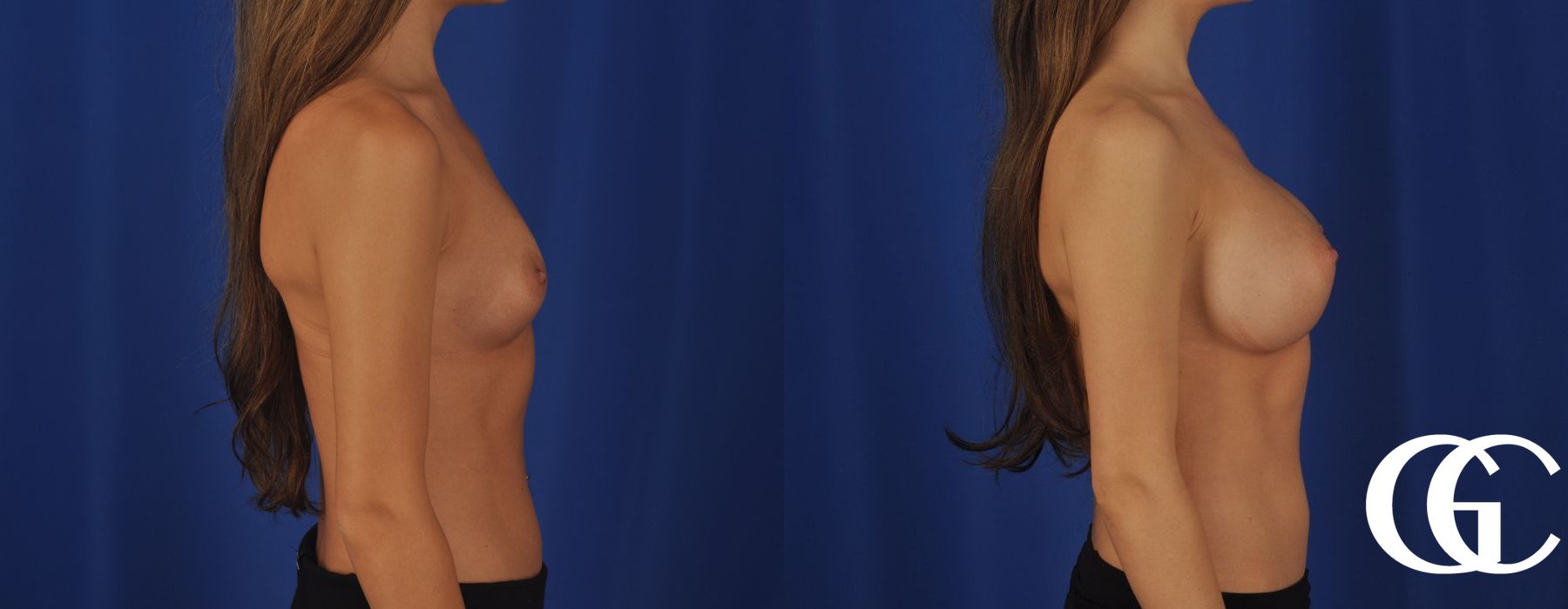 Breast Augmentation - Thumbnail 3