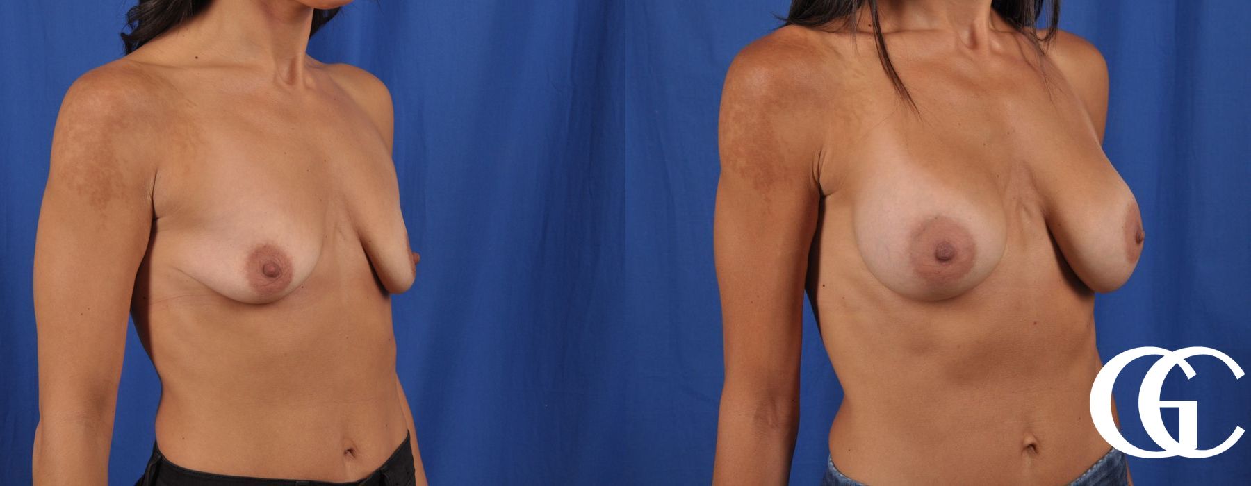 Breast Augmentation - Thumbnail 2