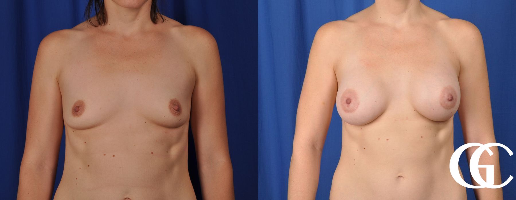 Breast Augmentation - Case 7206