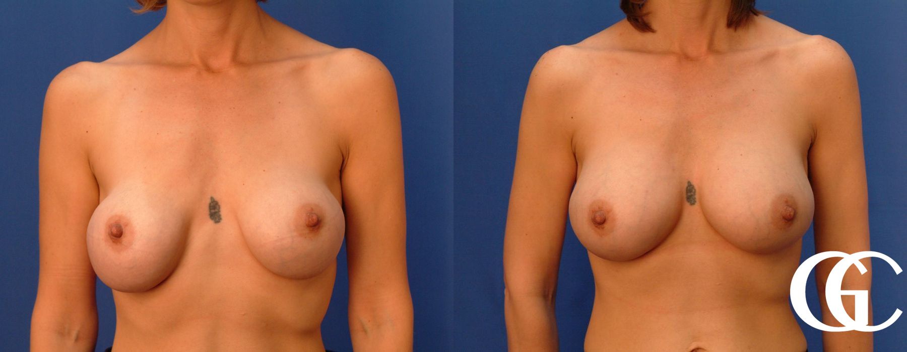 Breast Augmentation - Case 7078