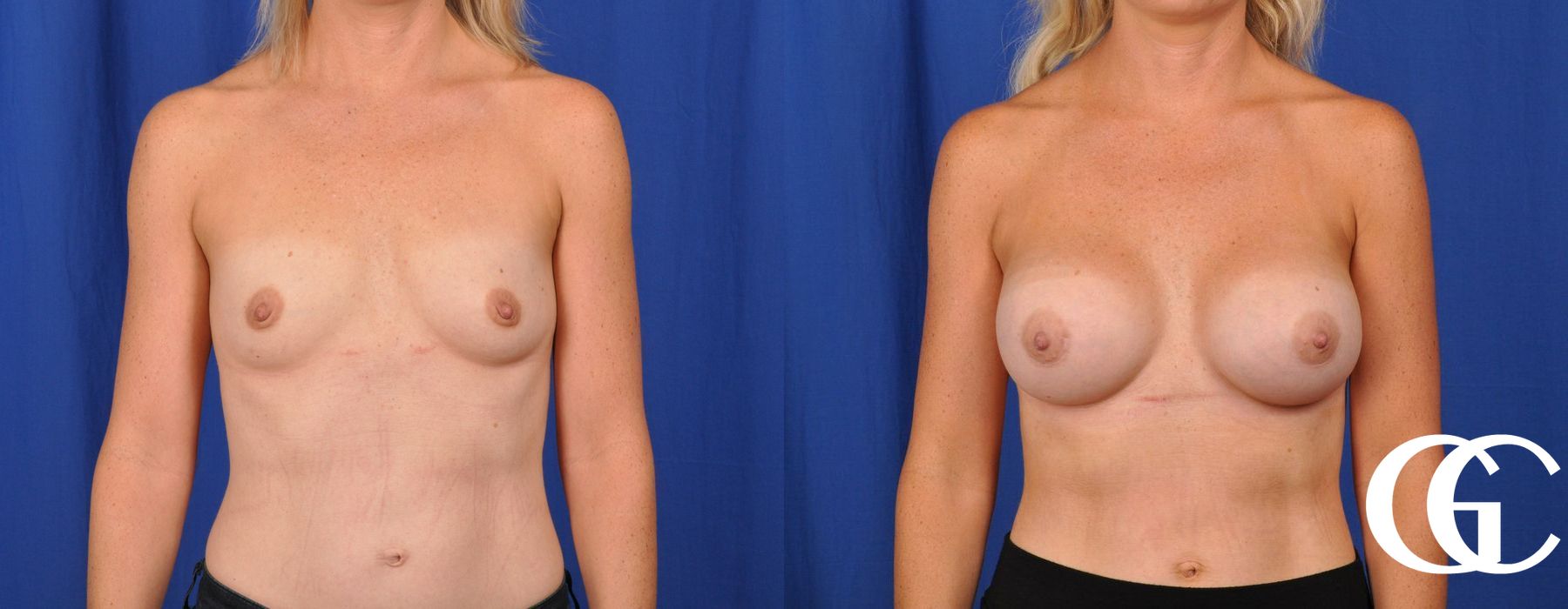Breast Augmentation - Thumbnail 2