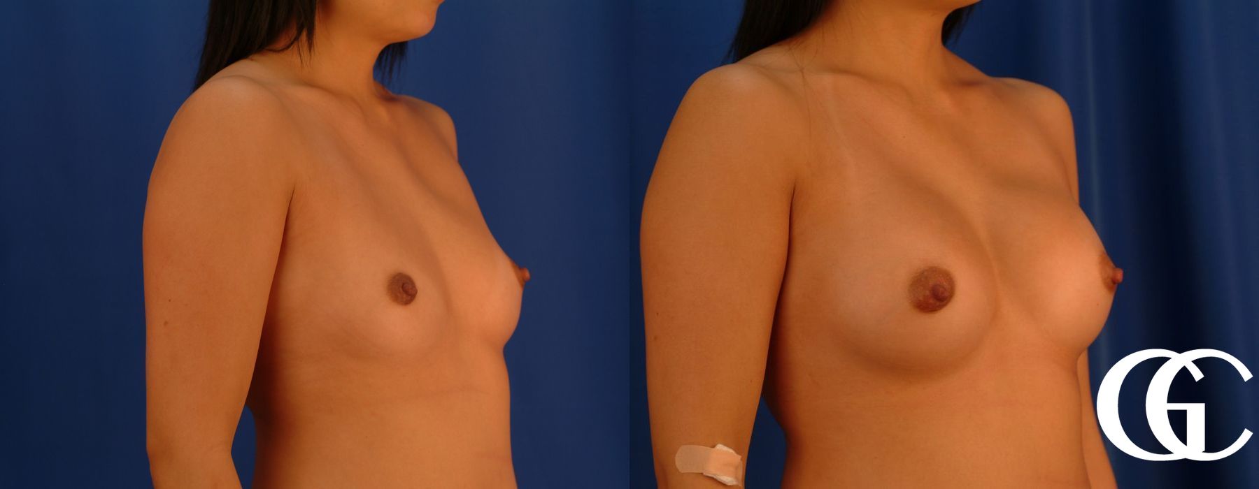 Breast Augmentation - Case 7106