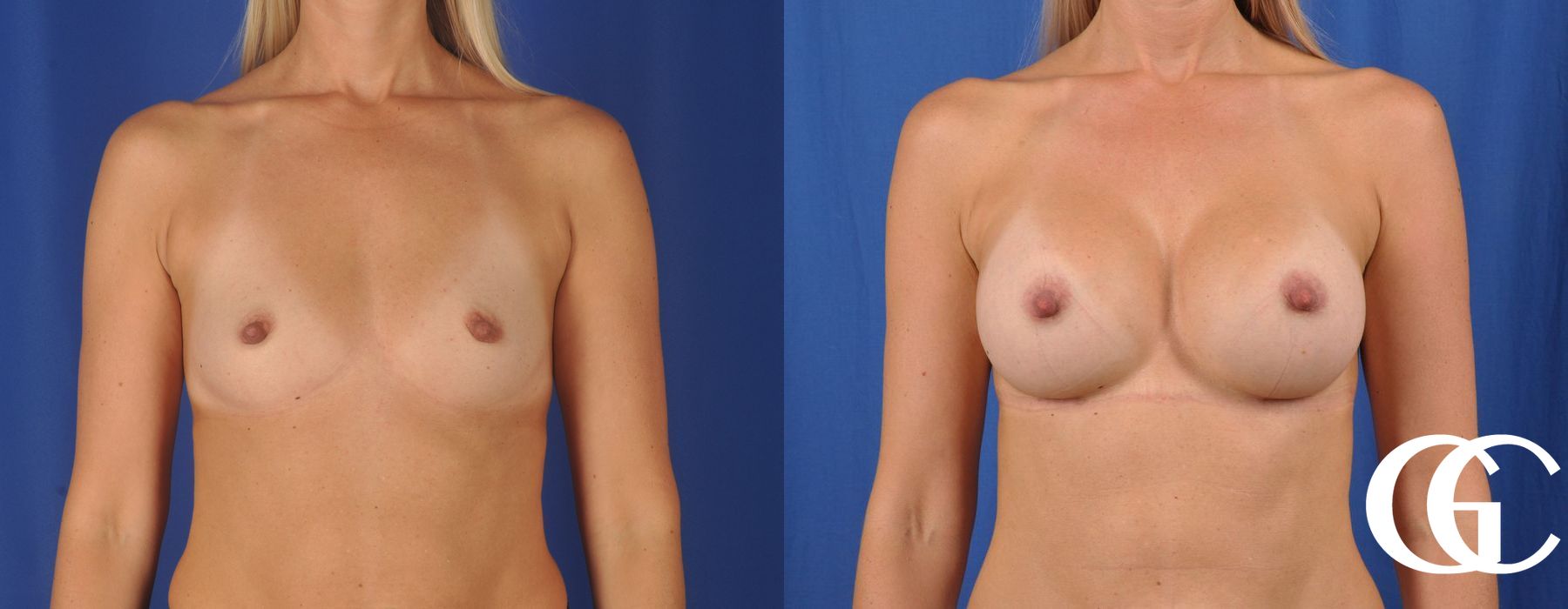 Breast Augmentation - Thumbnail 2
