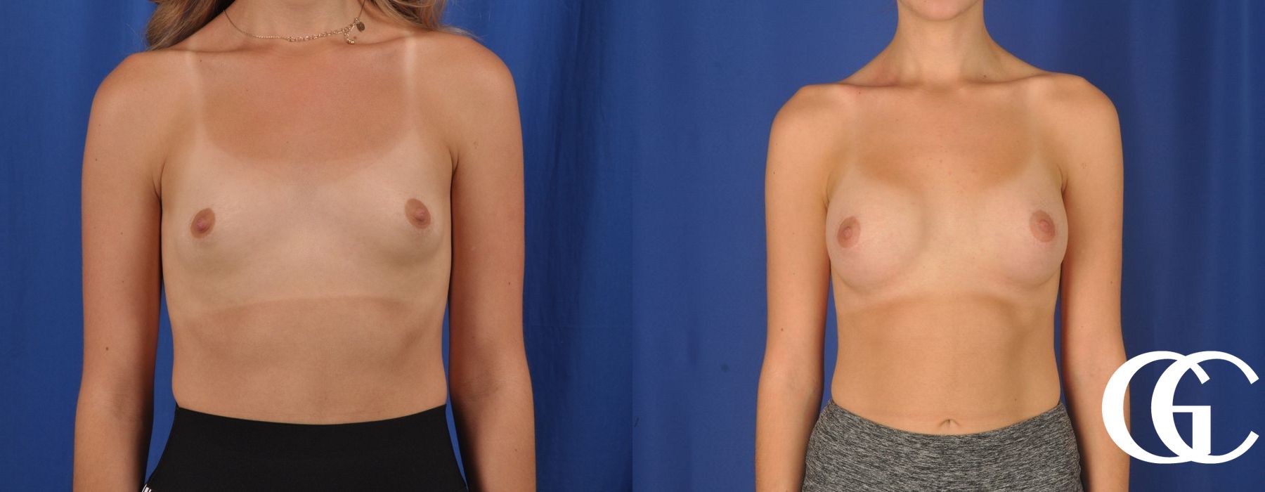 Breast Augmentation - Thumbnail 2