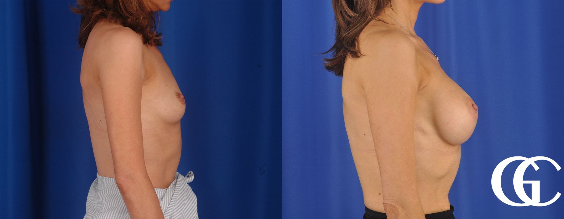 Breast Augmentation - Case 7049