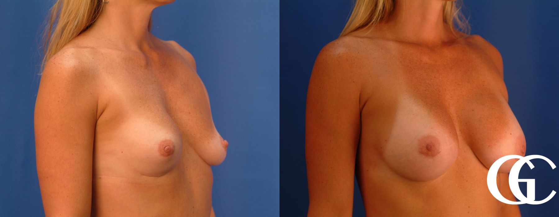 Breast Augmentation - Case 7079