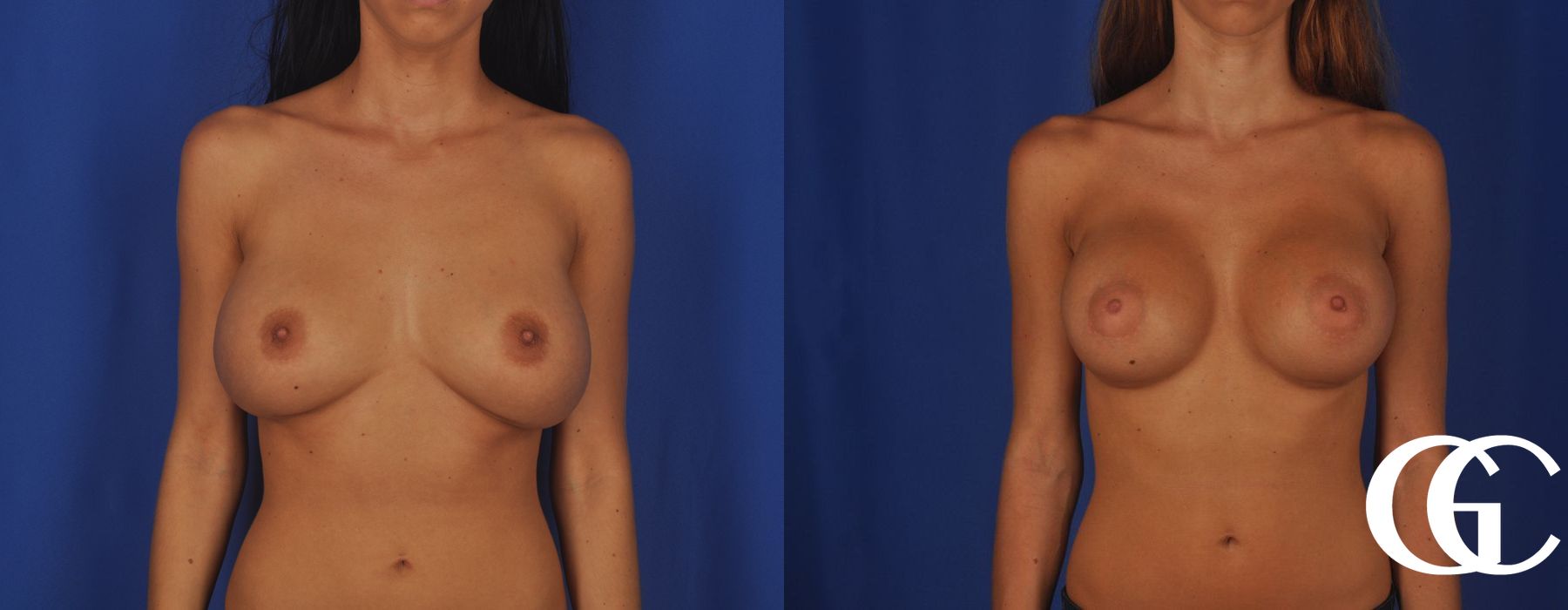Breast Augmentation - Case 7198