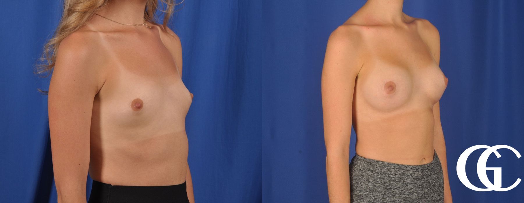 Breast Augmentation - Case 7119