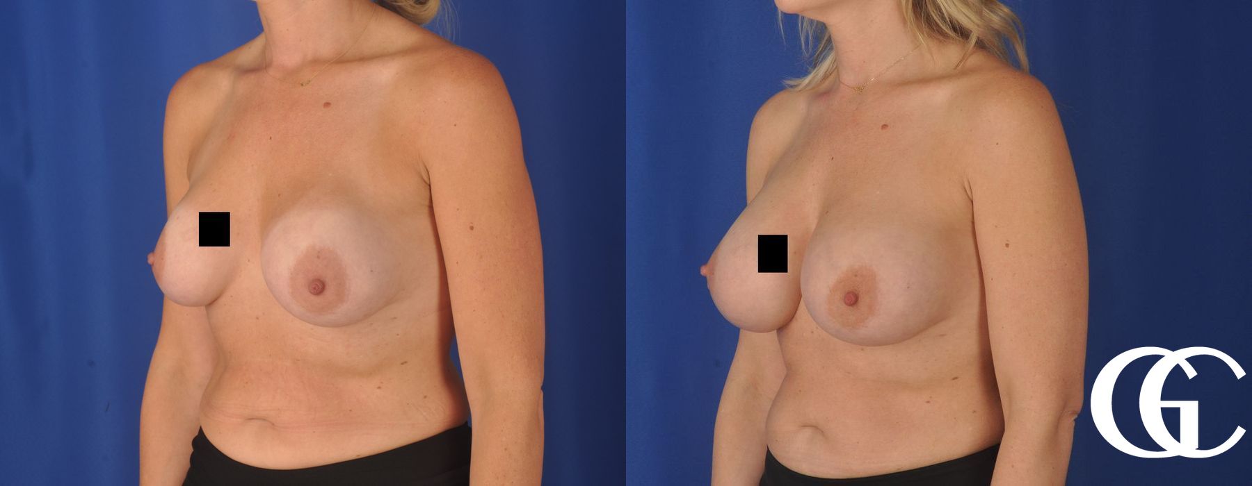 Breast Augmentation - Thumbnail 2