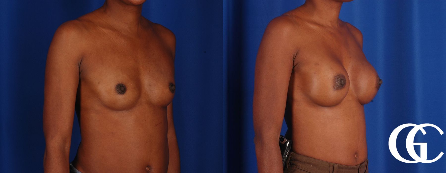 Breast Augmentation - Thumbnail 4