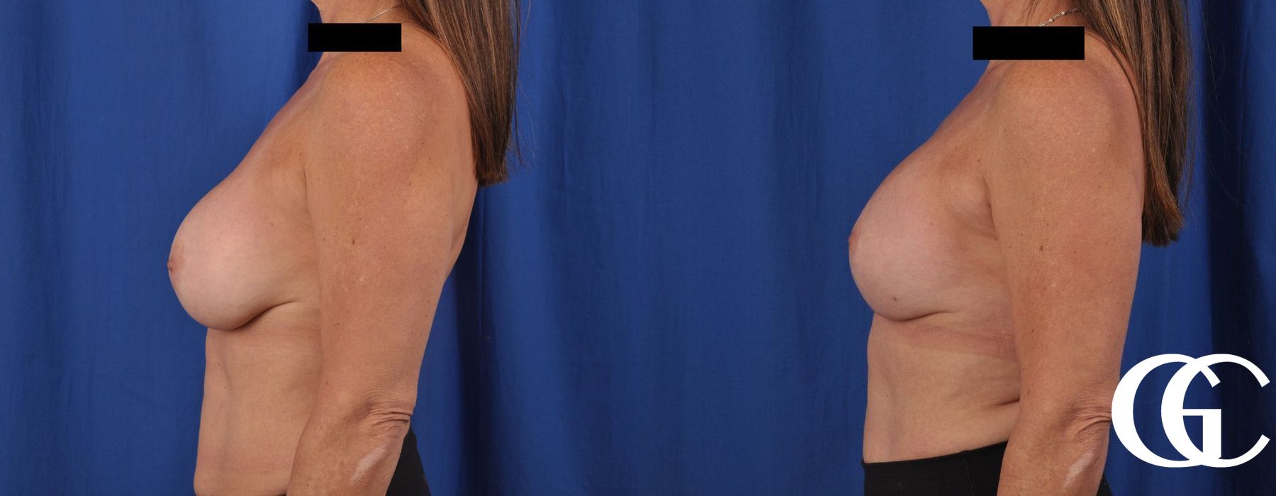 Breast Augmentation - Thumbnail 4