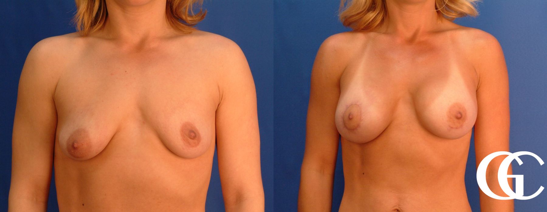 Breast Augmentation - Thumbnail 2