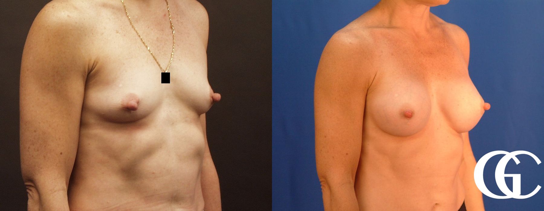 Breast Augmentation - Thumbnail 3