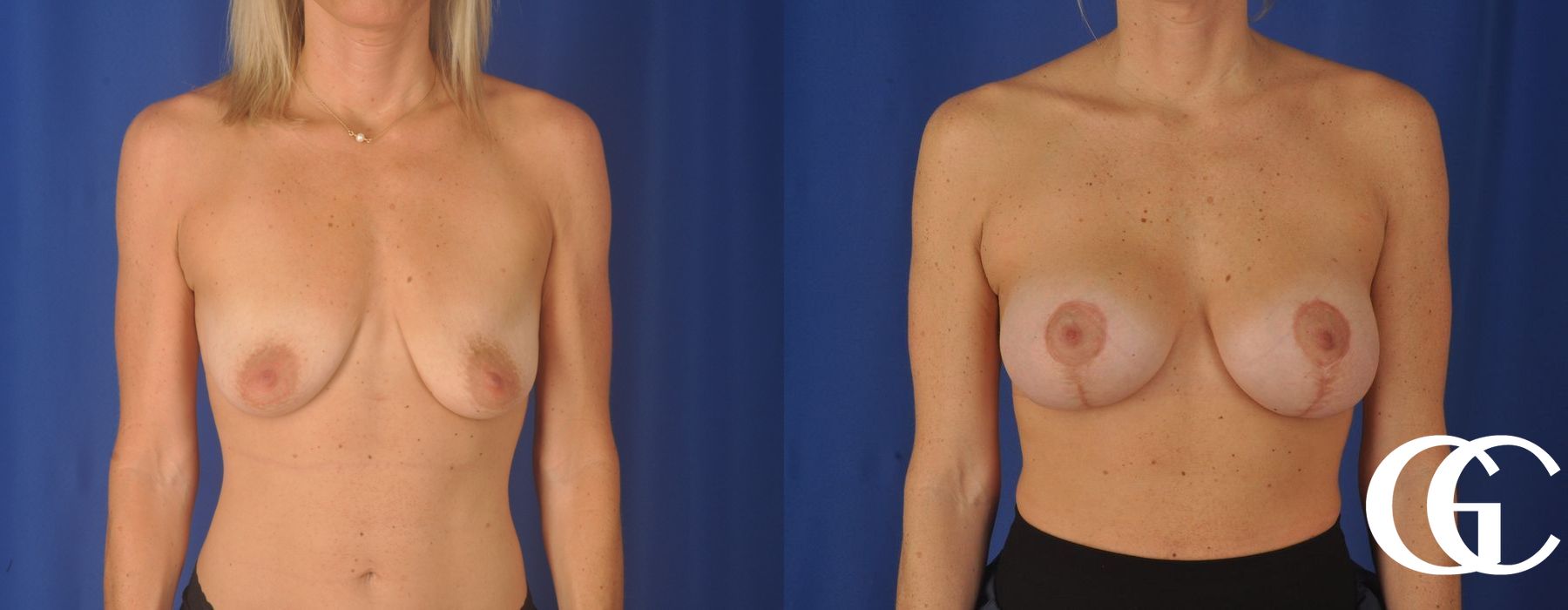 Breast Augmentation - Case 7116