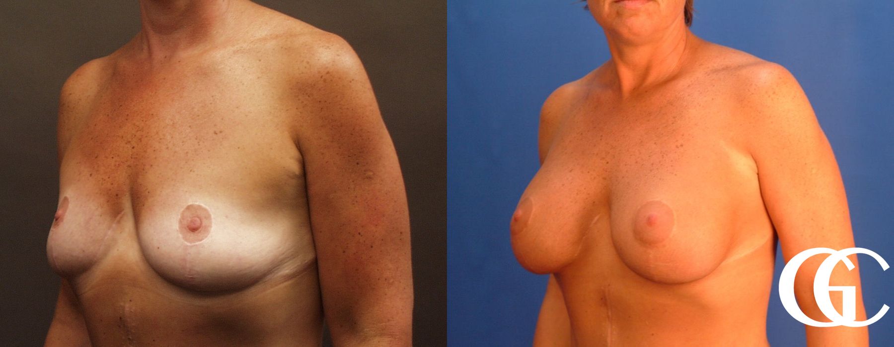 Breast Augmentation - Case 7097
