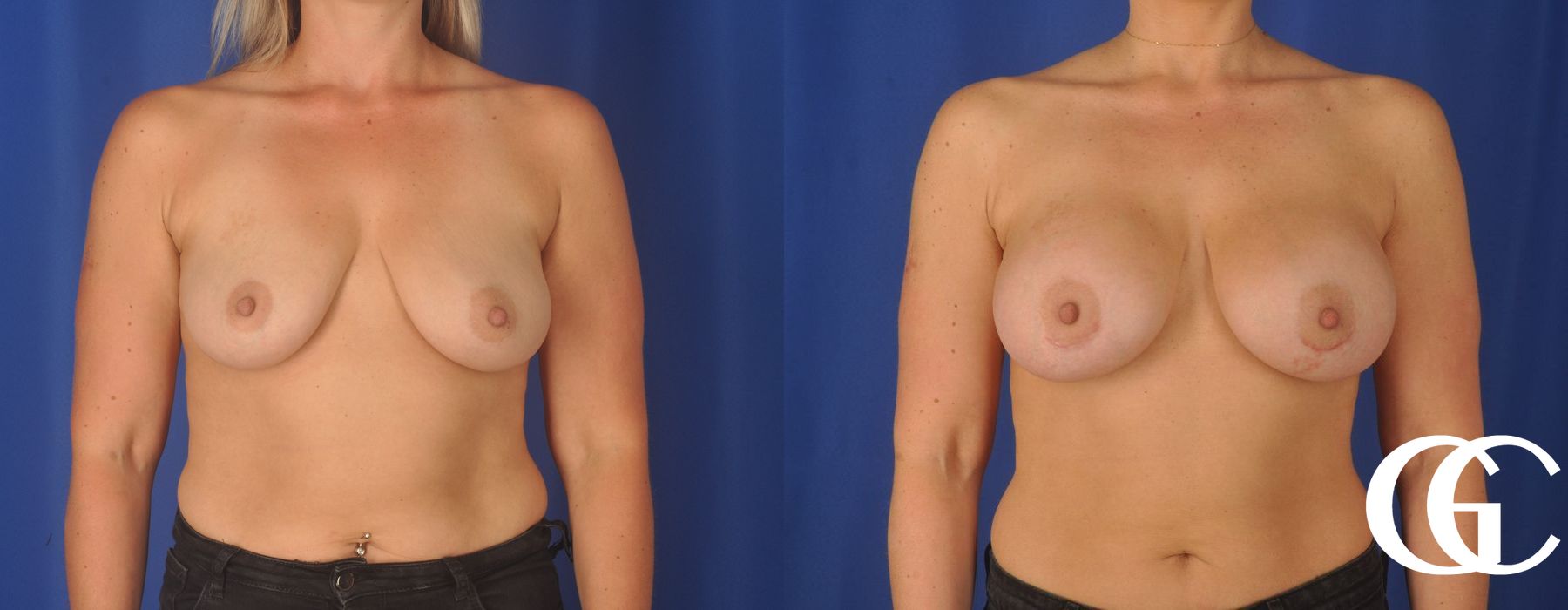 Breast Augmentation - Thumbnail 4
