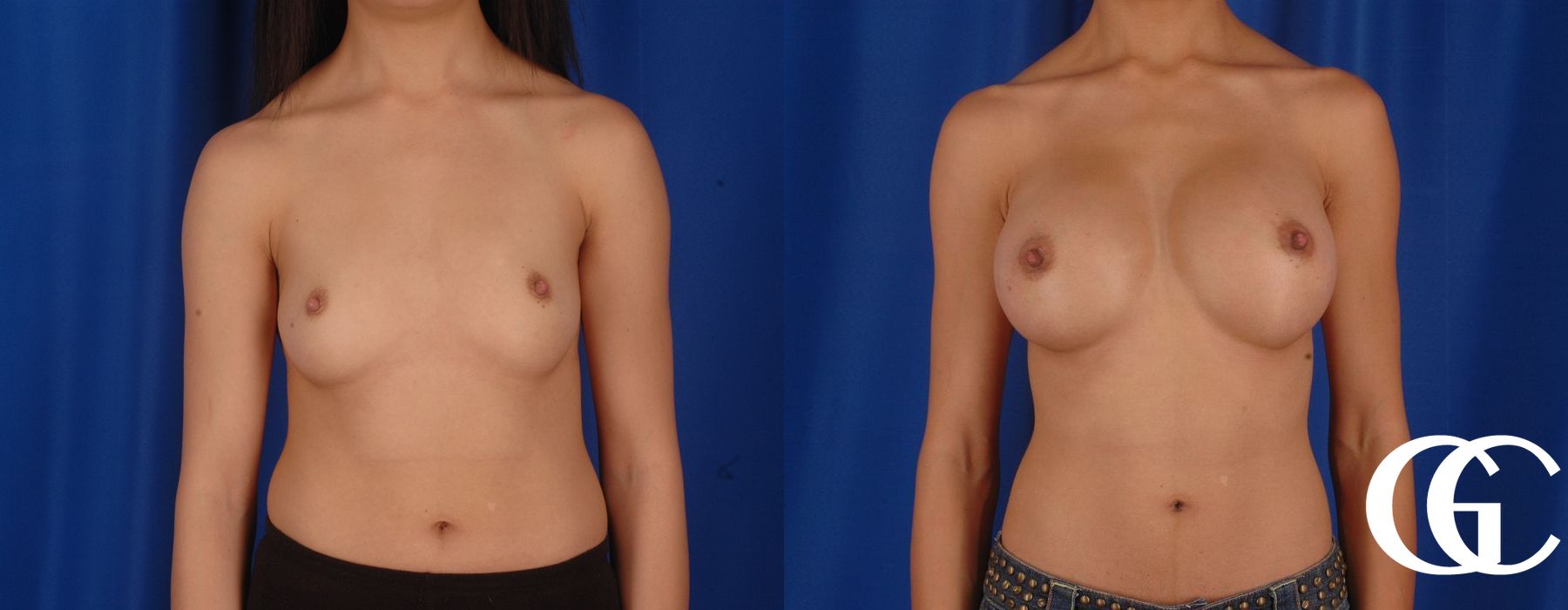 Breast Augmentation - Case 7060