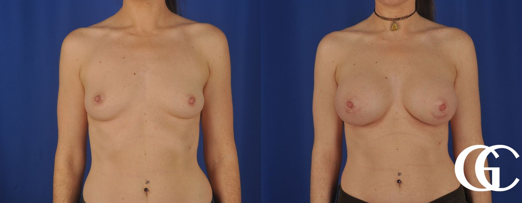 Breast Augmentation - Thumbnail 2