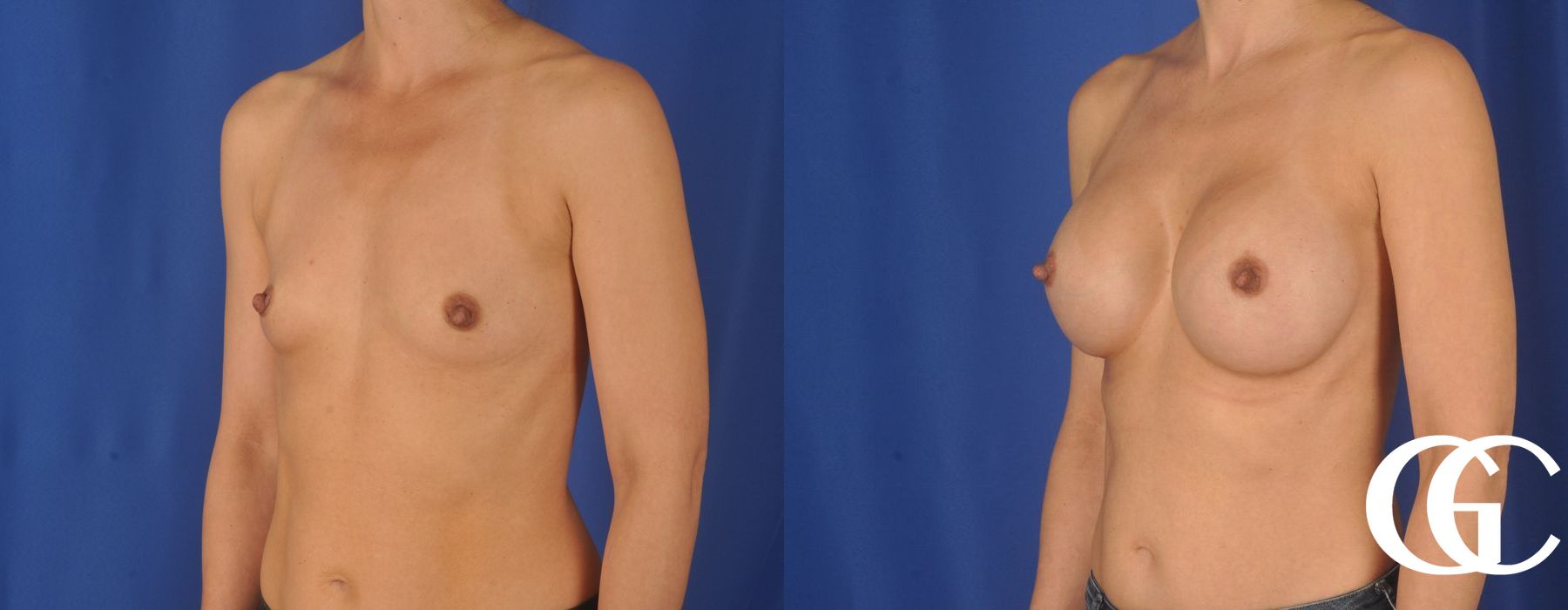 Breast Augmentation - Thumbnail 4
