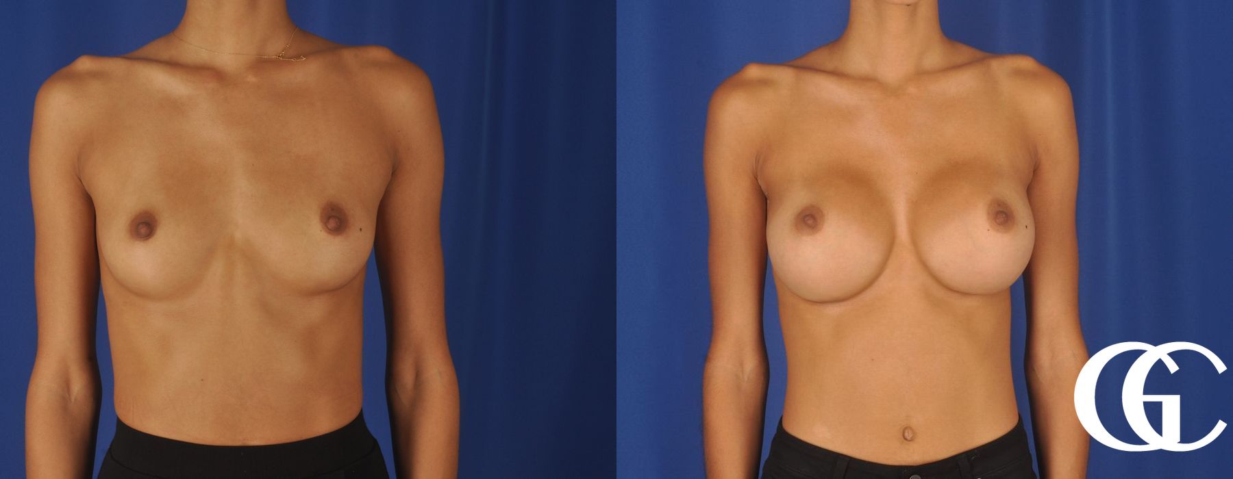 Breast Augmentation - Case 7121