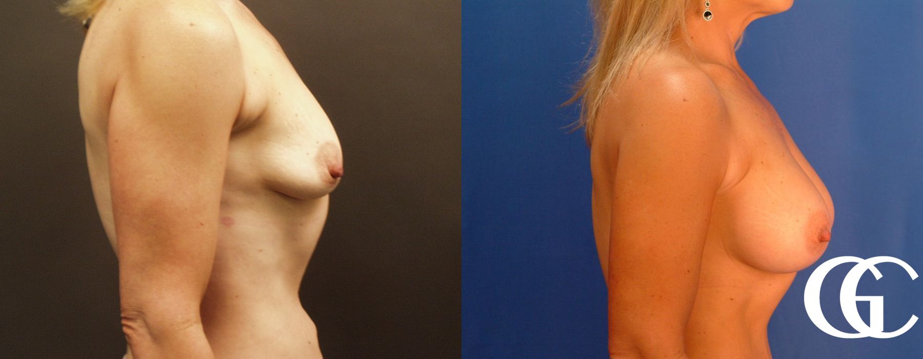 Breast Augmentation - Thumbnail 3