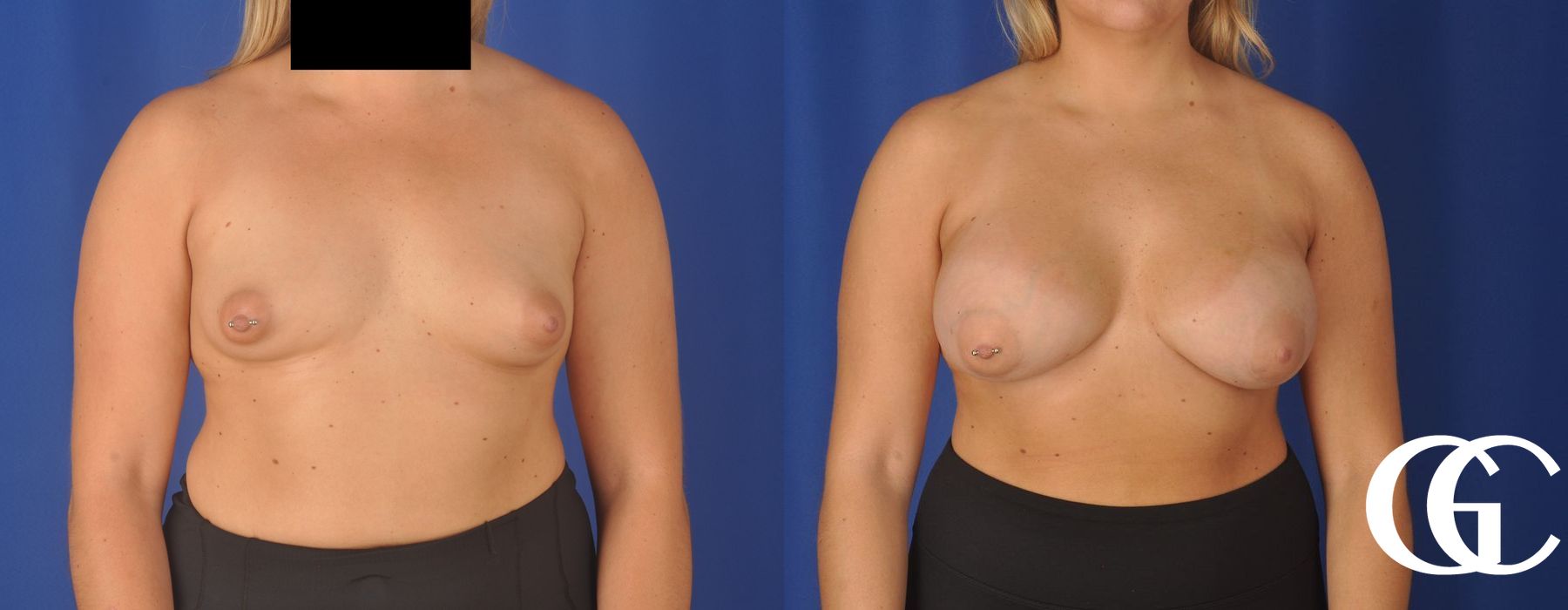 Breast Augmentation - Thumbnail 2