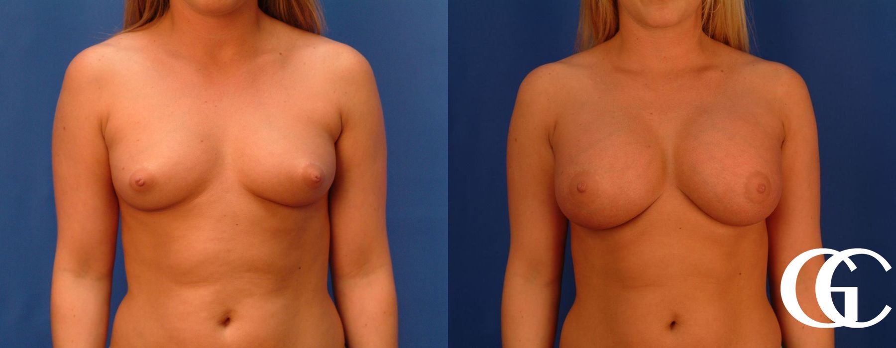 Breast Augmentation - Case 7089