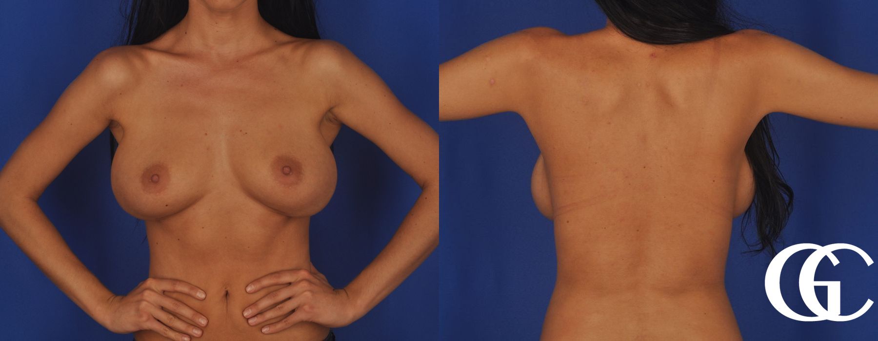 Breast Augmentation - Thumbnail 3