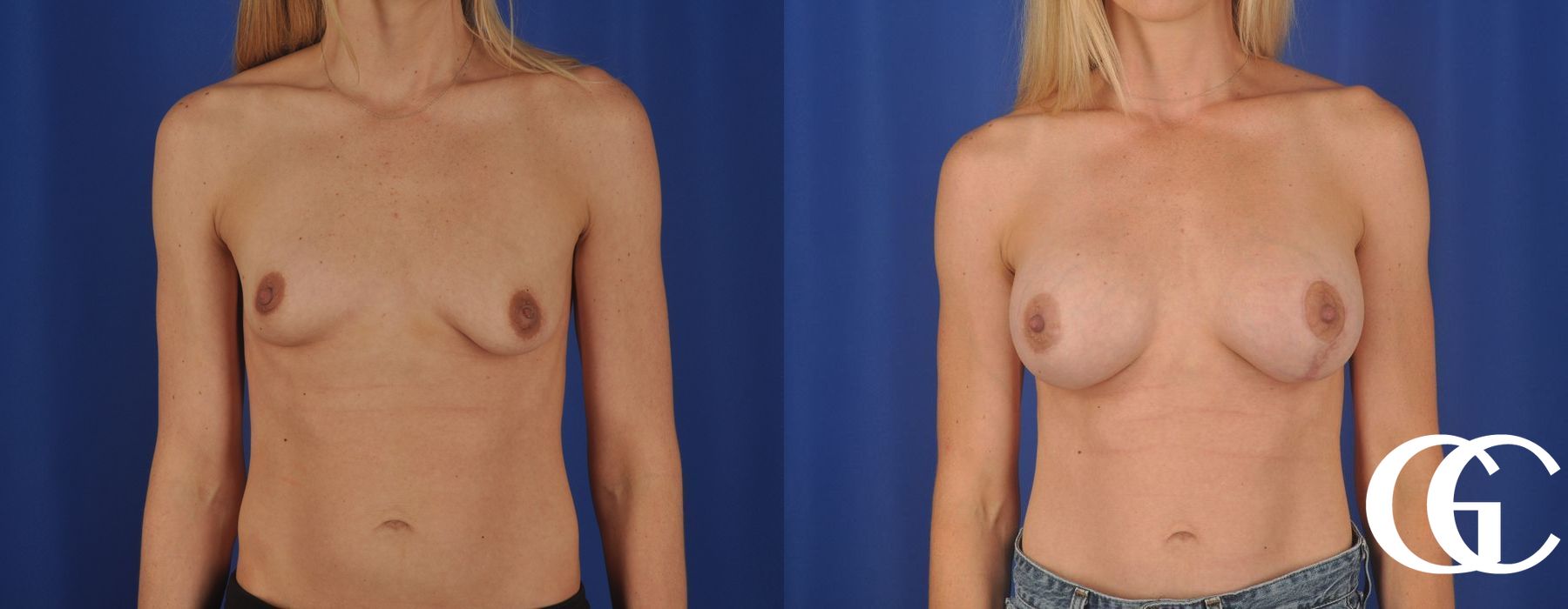 Breast Augmentation - Thumbnail 2