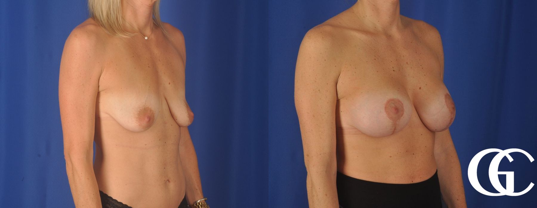 Breast Augmentation - Thumbnail 4