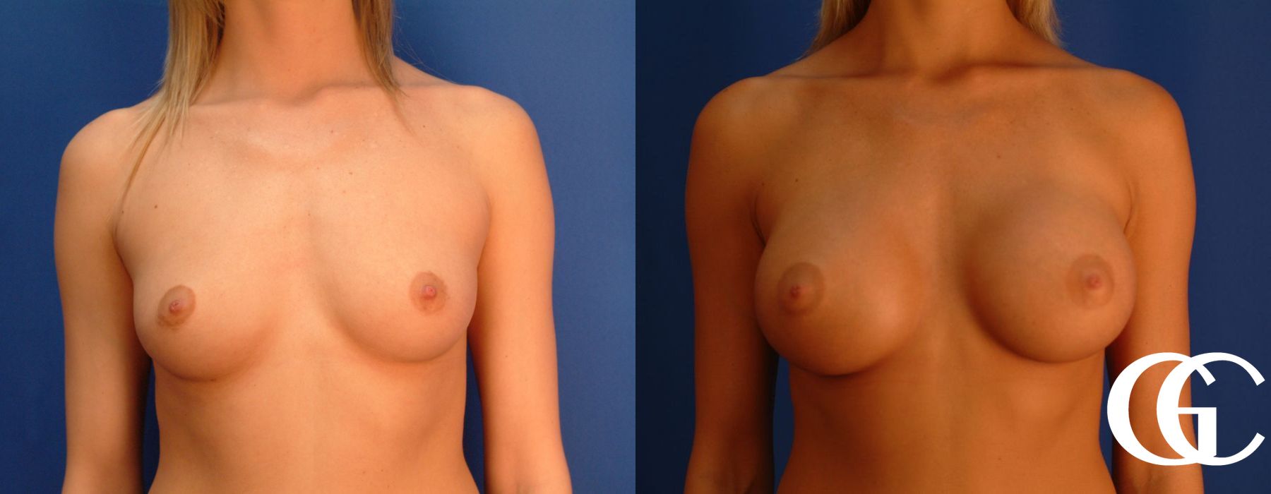 Breast Augmentation - Thumbnail 2