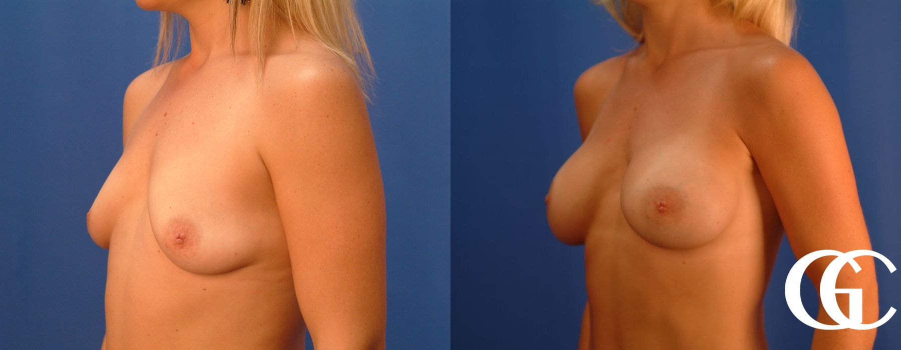 Breast Augmentation - Case 7063