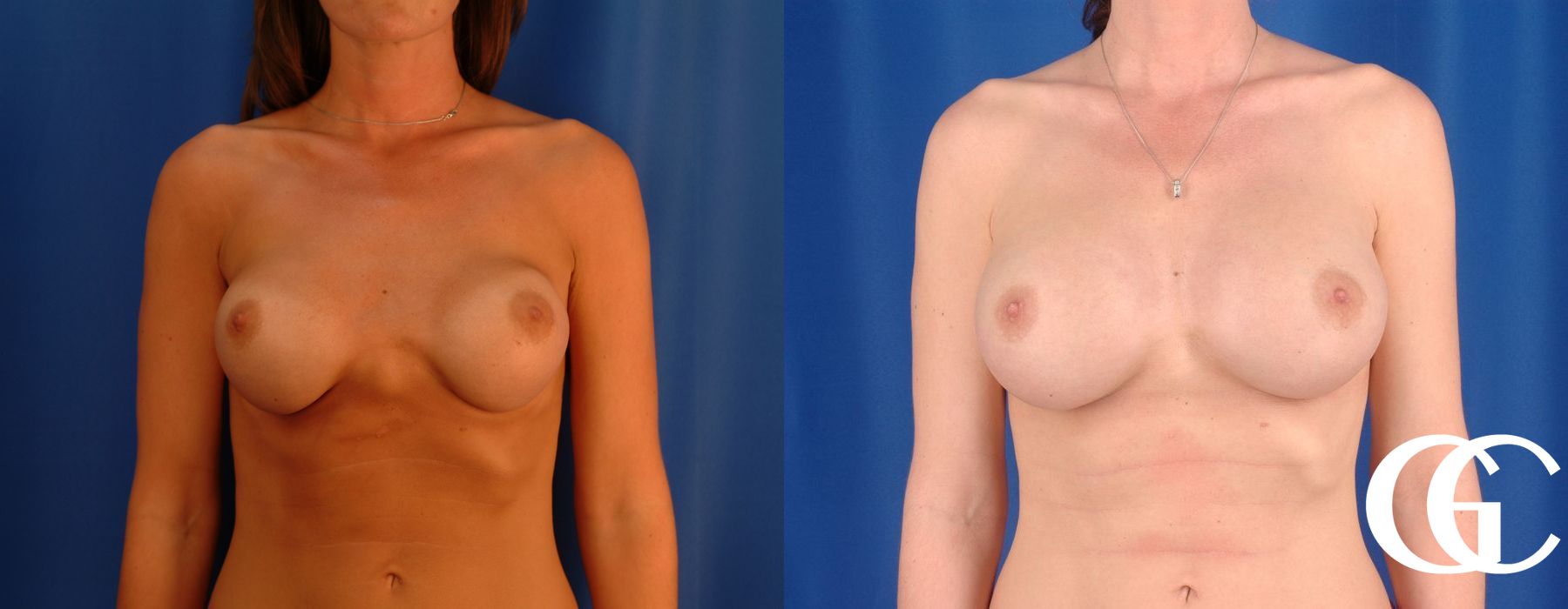 Breast Augmentation - Thumbnail 2