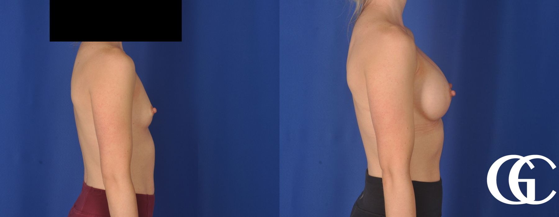 Breast Augmentation - Thumbnail 3