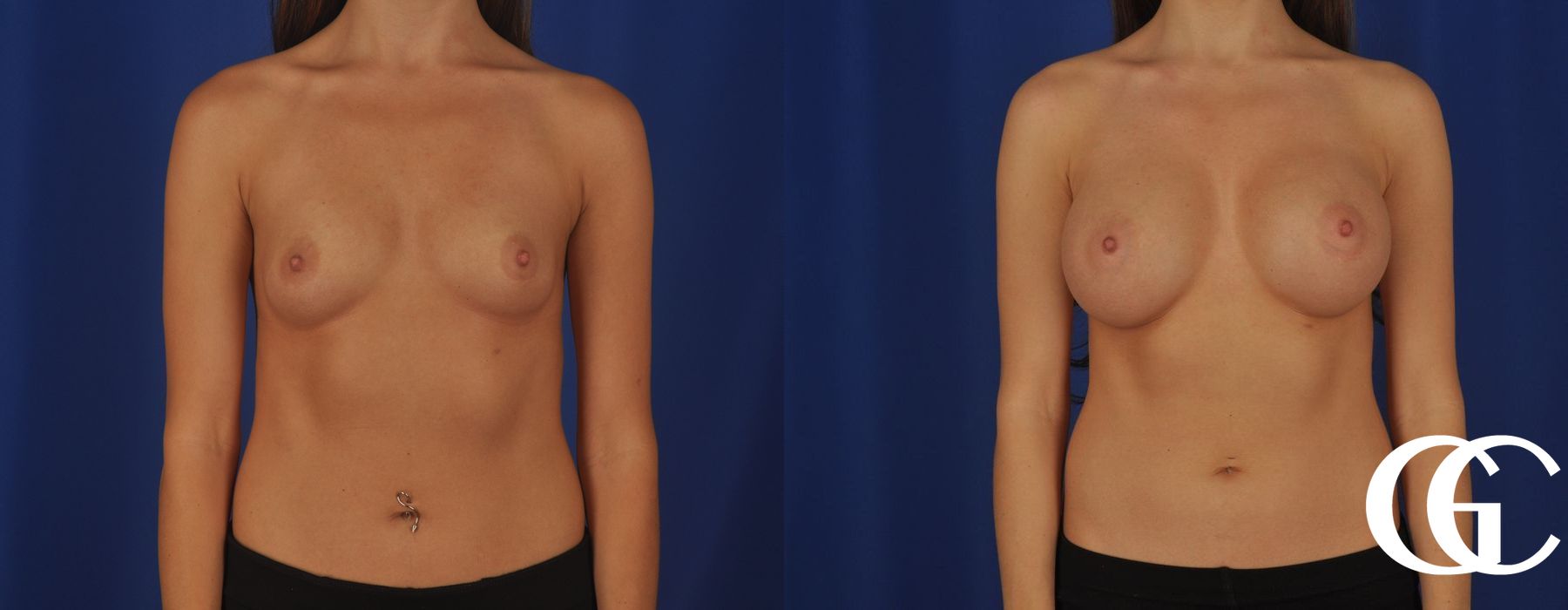Breast Augmentation - Thumbnail 4