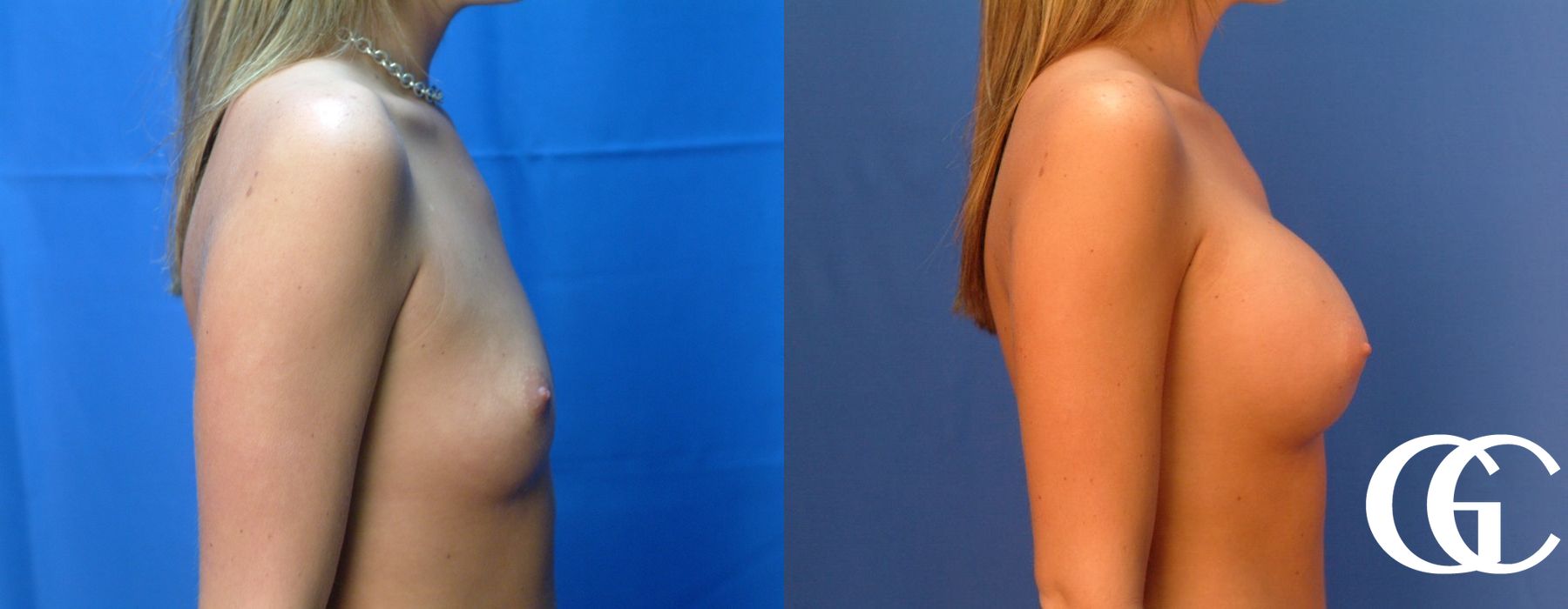 Breast Augmentation - Thumbnail 3